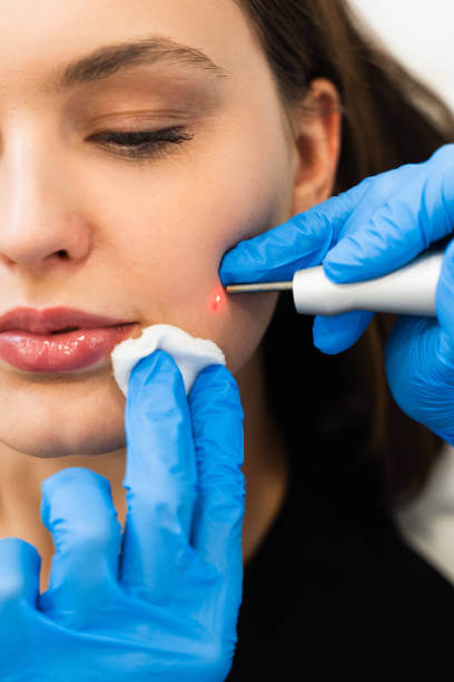 평편사마귀 제거 완벽 가이드! 흉터 없이 사마귀 없애는 최신 치료법?