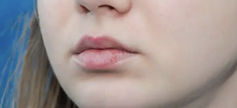 입술에 물집이 생기는 이유 18