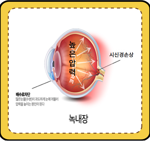 녹내장 증상