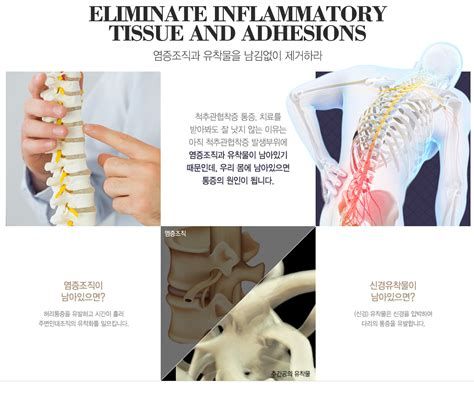 척추 협착증 원인