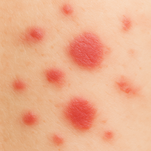 몸에 붉은 반점 원인