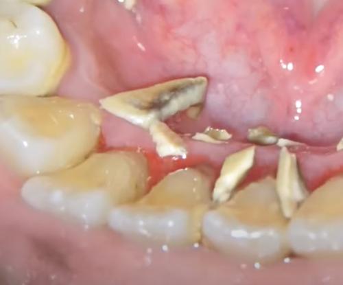 축적된 치석 제거중인 모습