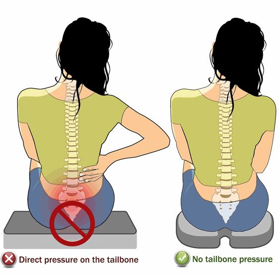 꼬리뼈 튀어나옴으로 인한 허리 통증