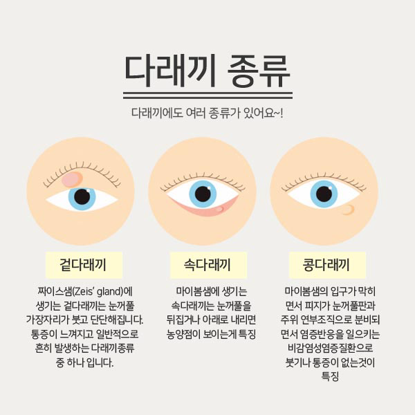 다래끼 원인 종류 빨리낫는법 눈다래끼 초기증상 치료 전염 찜질