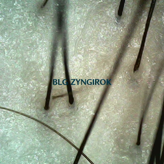 탈모 극복 프로젝트 - 정수리와 이마 사이 두피 모습이다.