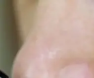 녹내장 초기 증상 &mdash; 시야를 서서히 빼앗는 침묵의 질환