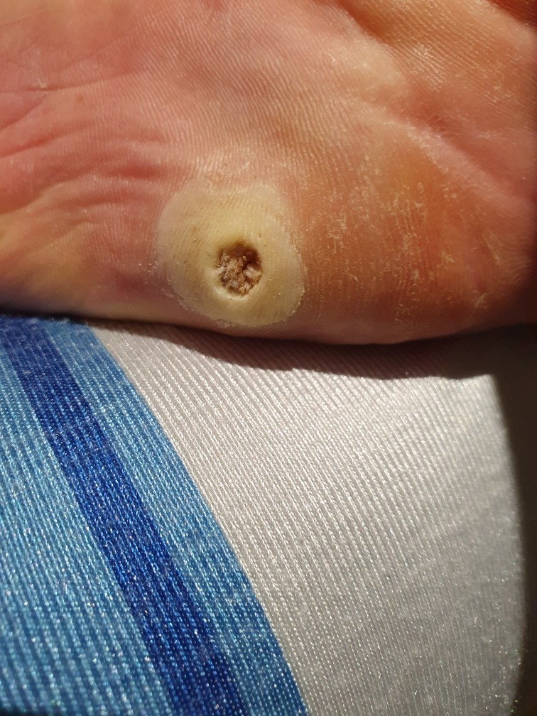 발바닥티눈사진