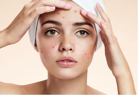 부위별 여드름 원인