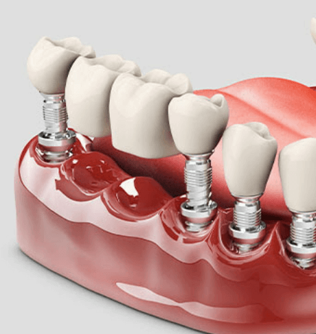 임플란트-주위염-치료하는-3가지-방법