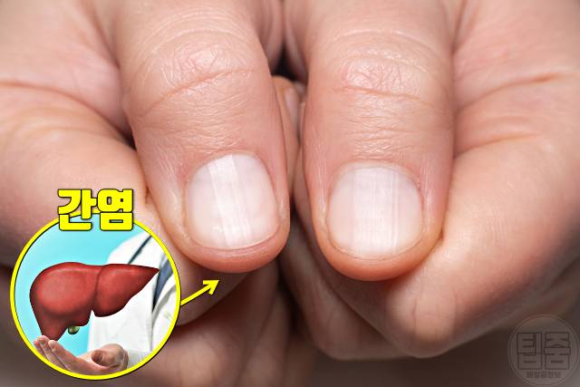 손톱 색깔 건강 손톱색깔 흰색 간염