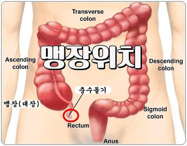 충수염 증상