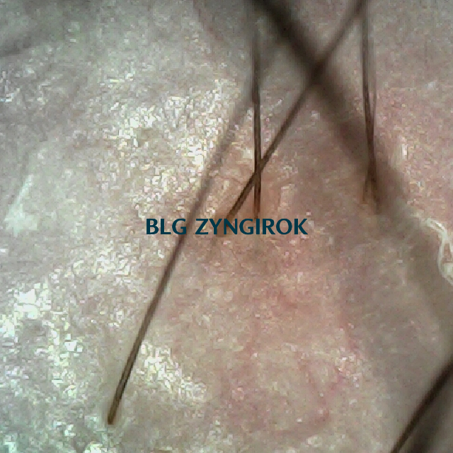 피나모아 복용 10주차 두피사진 - 오른쪽 M자 부위 모습이다.