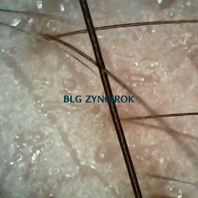 탈모 극복 프로젝트 - 오른쪽 M자 부위 두피 사진모습이다.