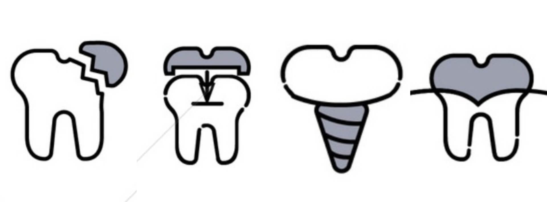 충치치료종류사진