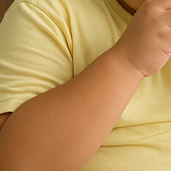 소아 비만 어린이