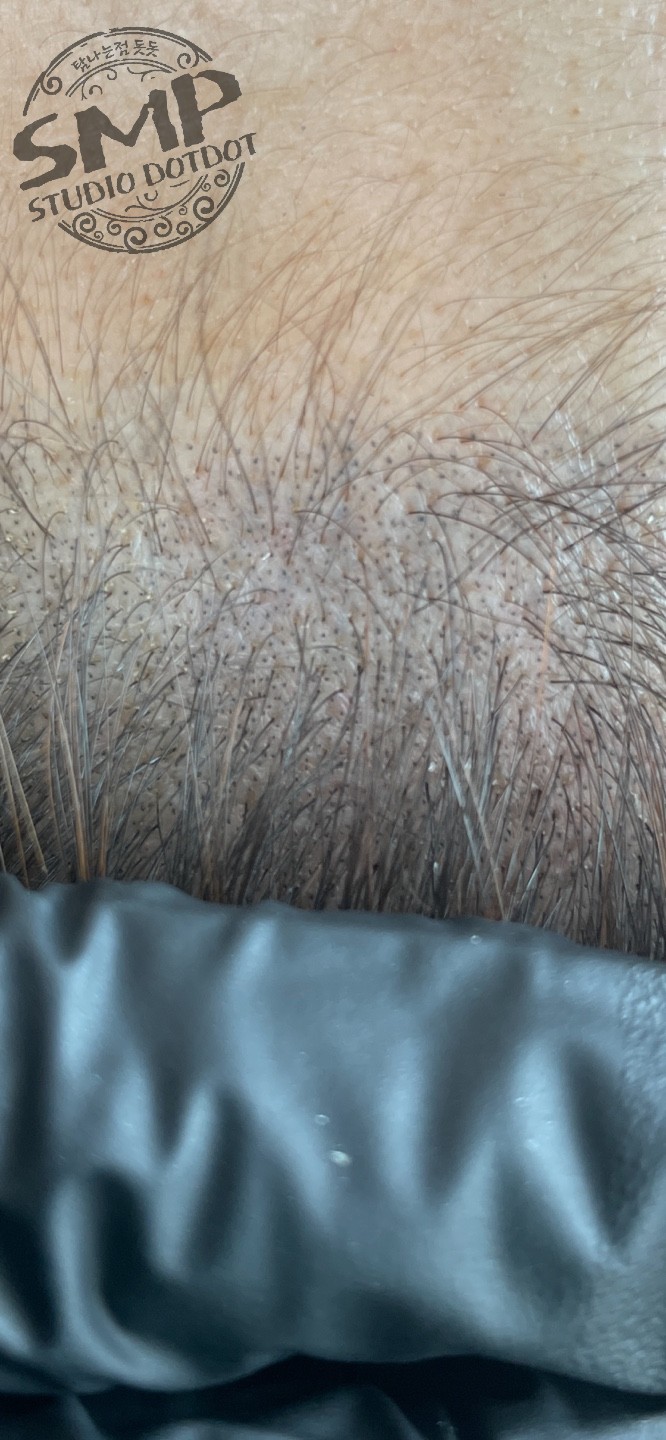 여자-헤어라인-두피문신