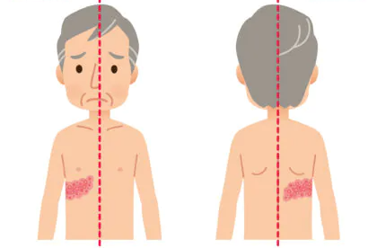 대상포진 초기증상