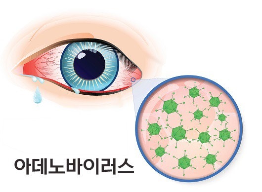 눈곱감기라고도 불리는 아데노바이러스를 표현한 그림