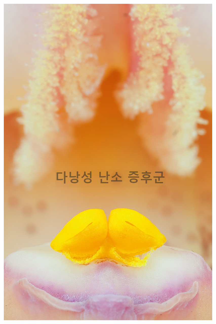 다낭성 난소증후군