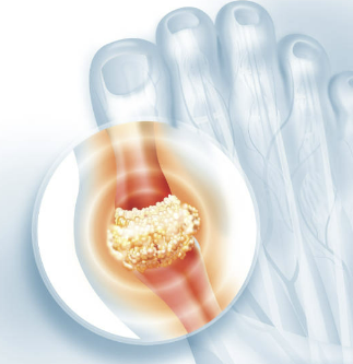 통풍 초기증상 치료법, 좋은 음식에 대한 모든 것 확인