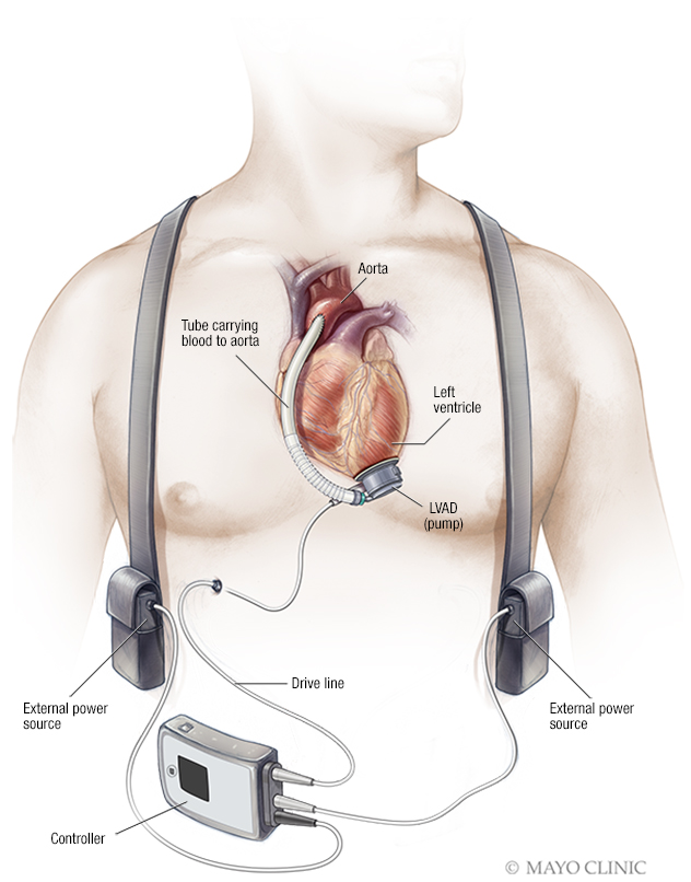 LVAD