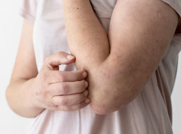 대상포진 초기증상 14