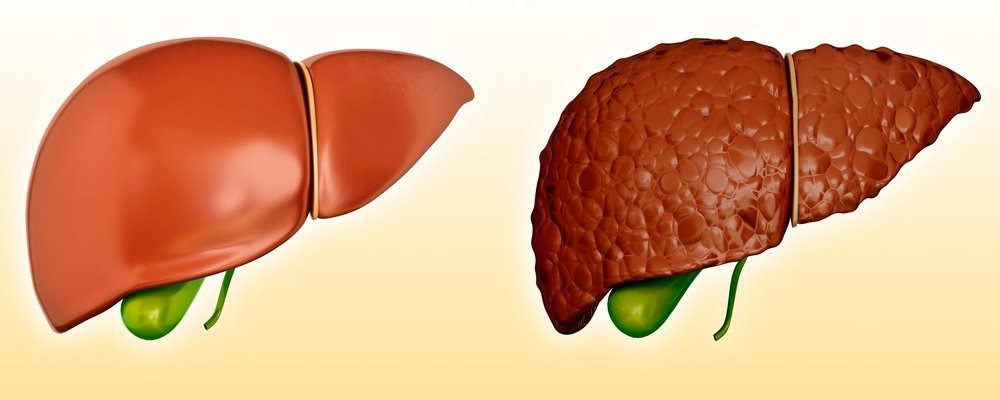 간경화증 증상&middot;원인&middot;치료 핵심 정리