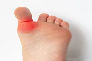 엄지발가락-통증