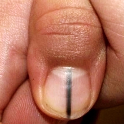 손톱에 세로줄이 생기는 이유