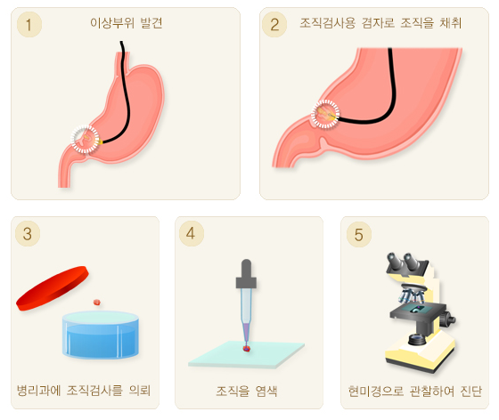 위내시경 조직검사 과정