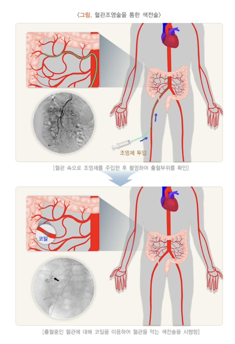 혈관조영술