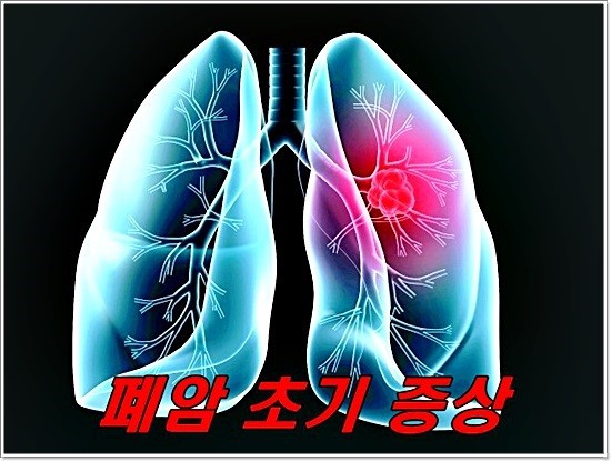 폐암 초기 증상