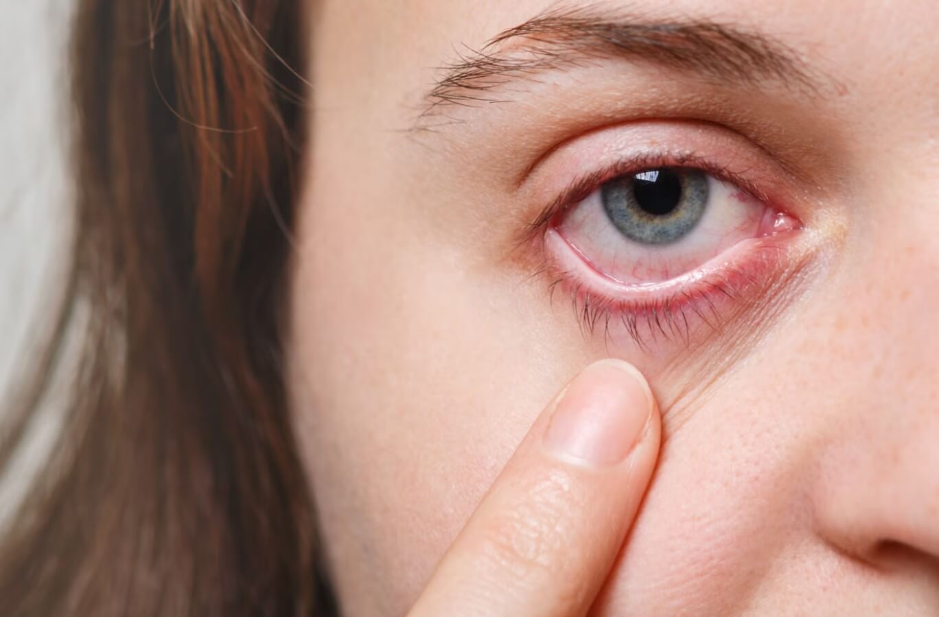 여성의 충혈된 한 쪽 눈