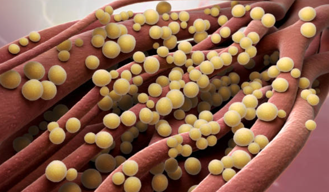 독성 쇼크 증후군과 관련된 사진2