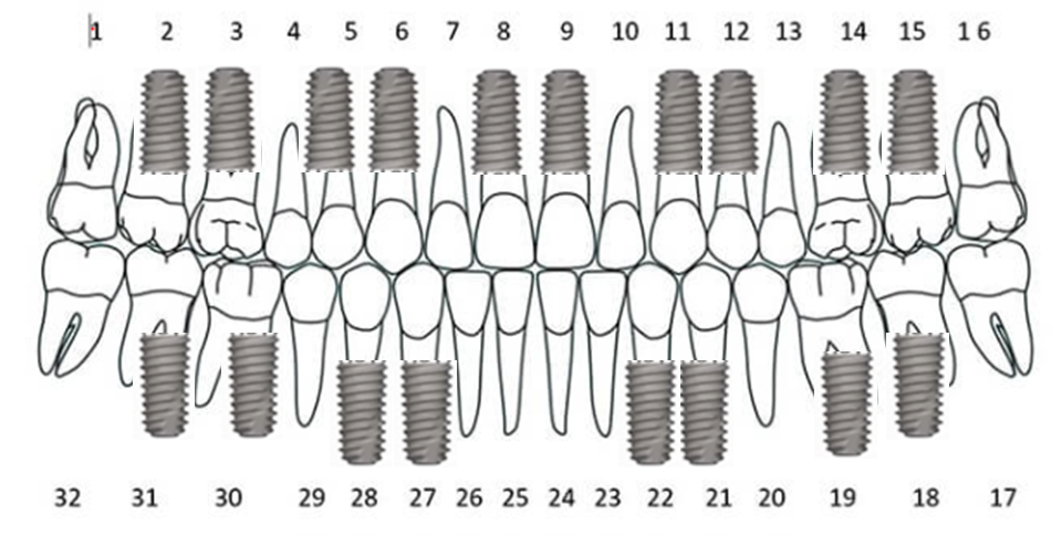 전체임플란트개수