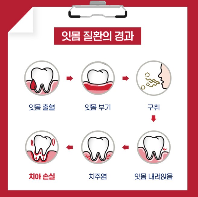 잇몸-질환의-경고를-단계별로-설명하고-있습니다.