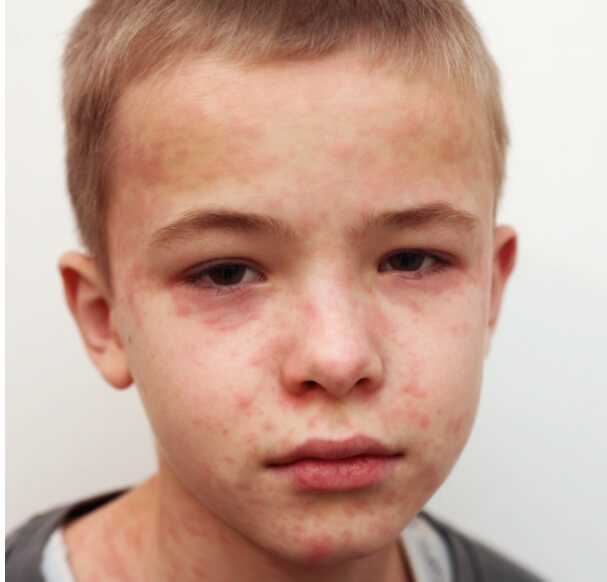 홍역예방접종 성인 홍역 예방접종