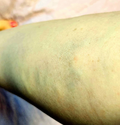 하지정맥류 초기 실제 사례