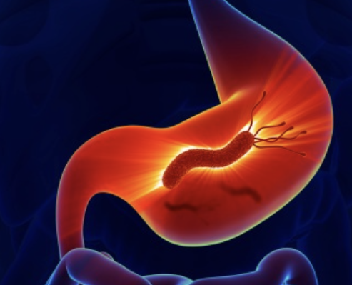 십이지장 궤양 증상 16