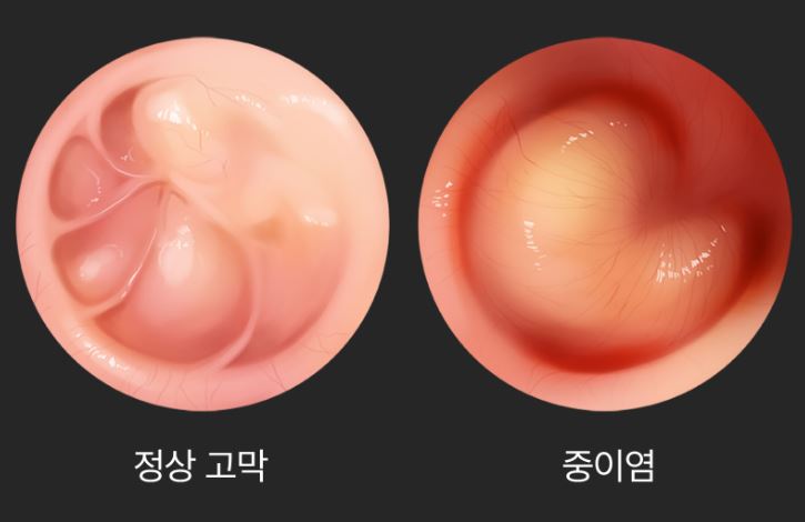중이염