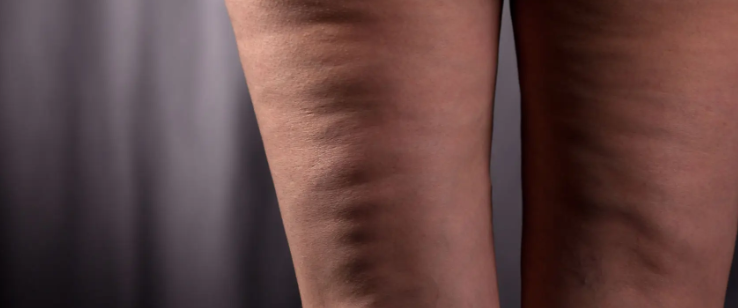 셀룰라이트 없애는 법 및 오일 (+ 크림 제거기 정보 허벅지 원인)