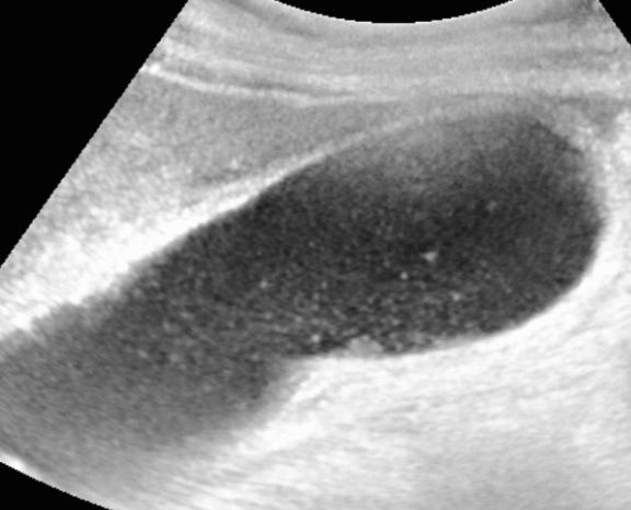 담즙 앙금 (GB Sludge)