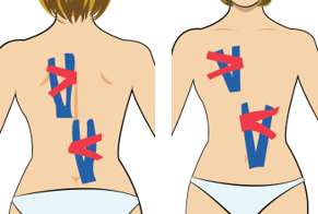 척추 측만증 (등이 좌측으로 휠 때)