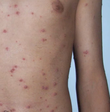 아시클로버 연고 효능