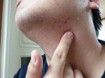 병풀 상처연고 상처 치유 피부 재생 효능과 사용법_20