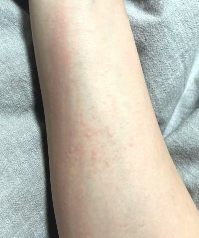 팔 좁쌀 두드러기