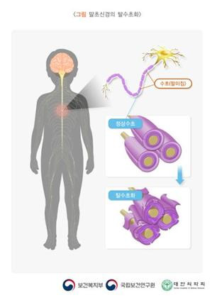 영아기의 비대성 신경병증(데제린-소타스 증후군)