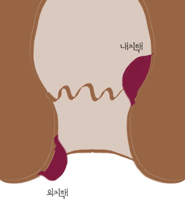 치질 (치핵, 치루) 증상, 원인과 치료