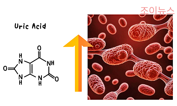통풍의 발생 원인