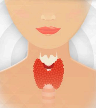 갑상선기능항진증(갑상선 항진증)